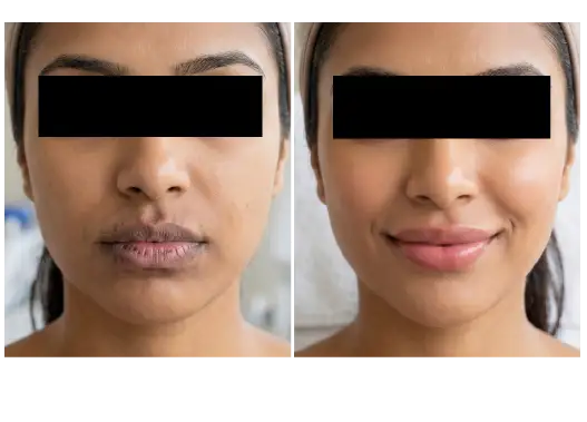 Before & After Advanced Lip Peel Treatment Results