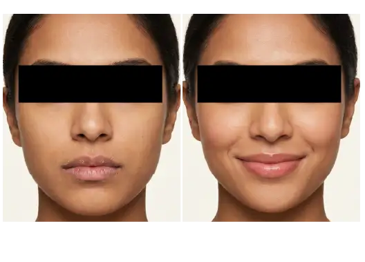 Before & After Advanced Lip Peel Treatment Results