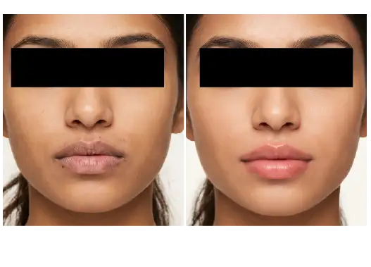 Before & After Advanced Lip Peel Treatment Results