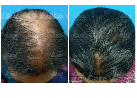 Before & After Alopecia Areata Treatment Results