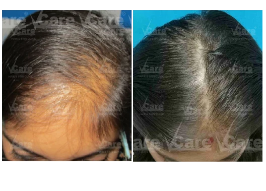 Before & After Alopecia Areata Treatment Results
