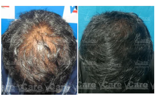 Before & After Alopecia Areata Treatment Results