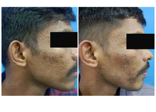 Before & After Cell Graft Skin Rejuvenation Treatment Results
