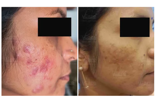 Before & After Cell Graft Skin Rejuvenation Treatment Results