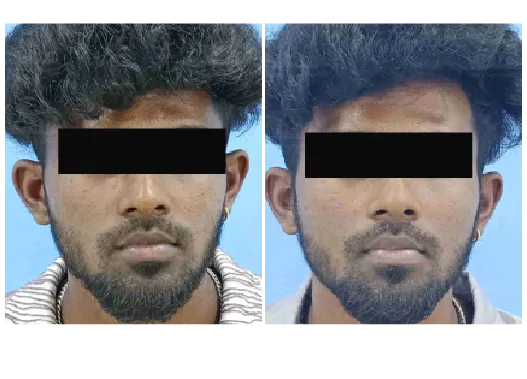 Before & After Cell Graft Skin Rejuvenation Treatment Results