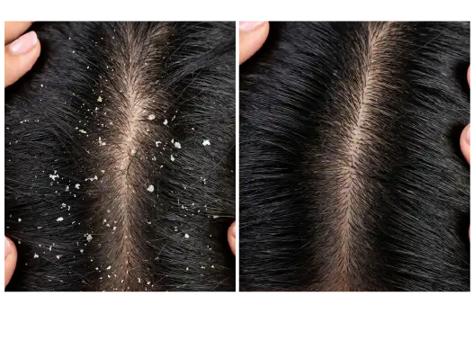 Before & After Dandruff Treatment Results