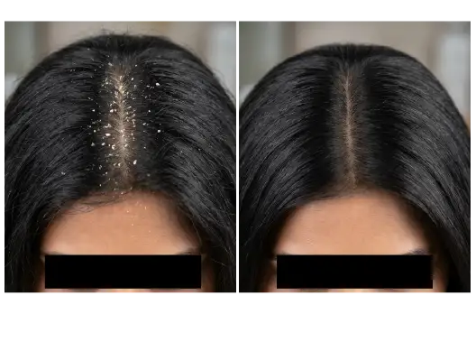 Before & After Dandruff Treatment Results