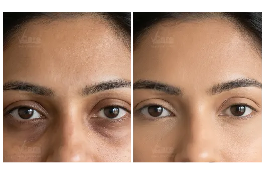 Before & After Dark Circle Treatment Results