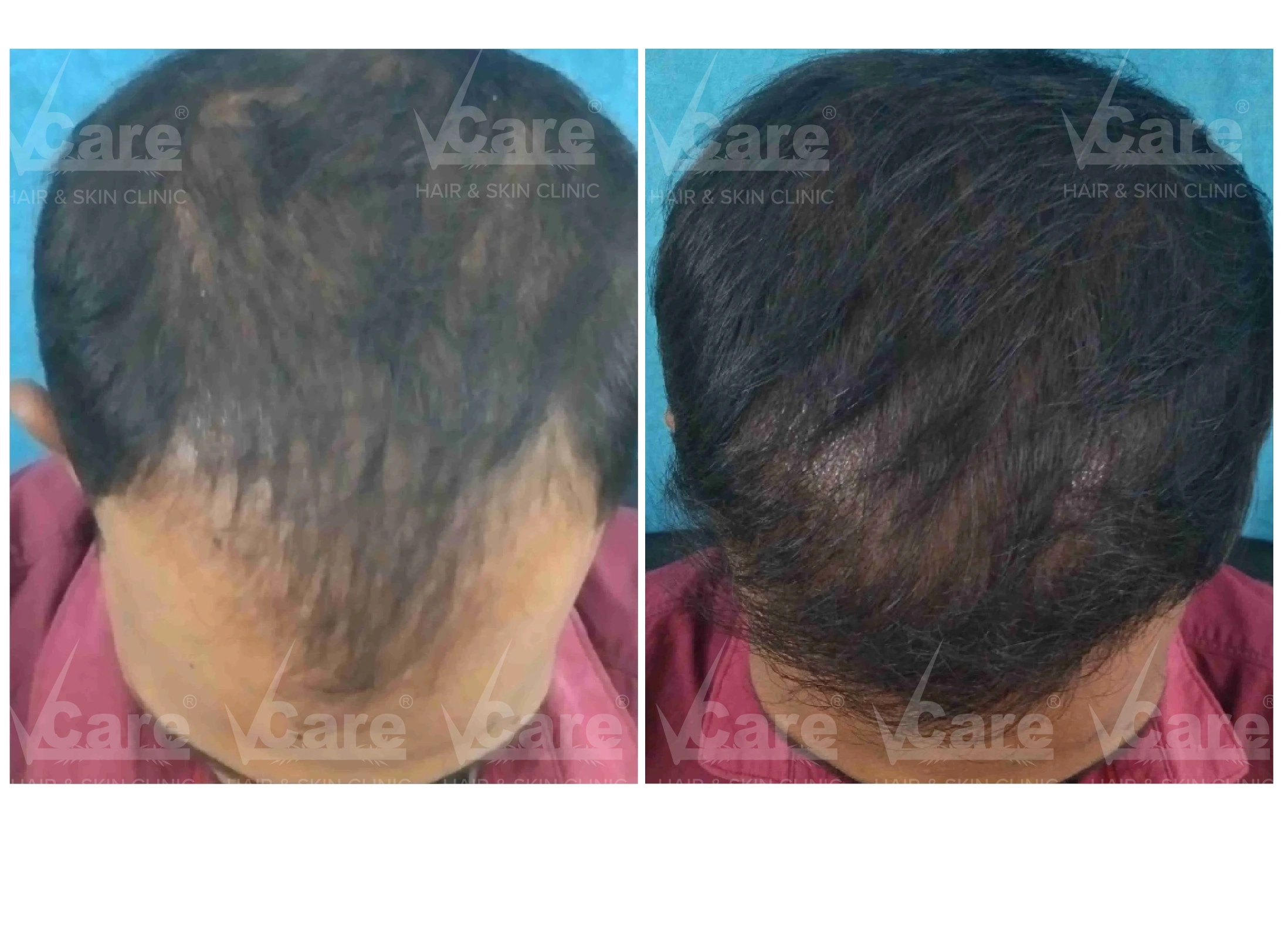 Before & After FUE Hair Transplantation Results