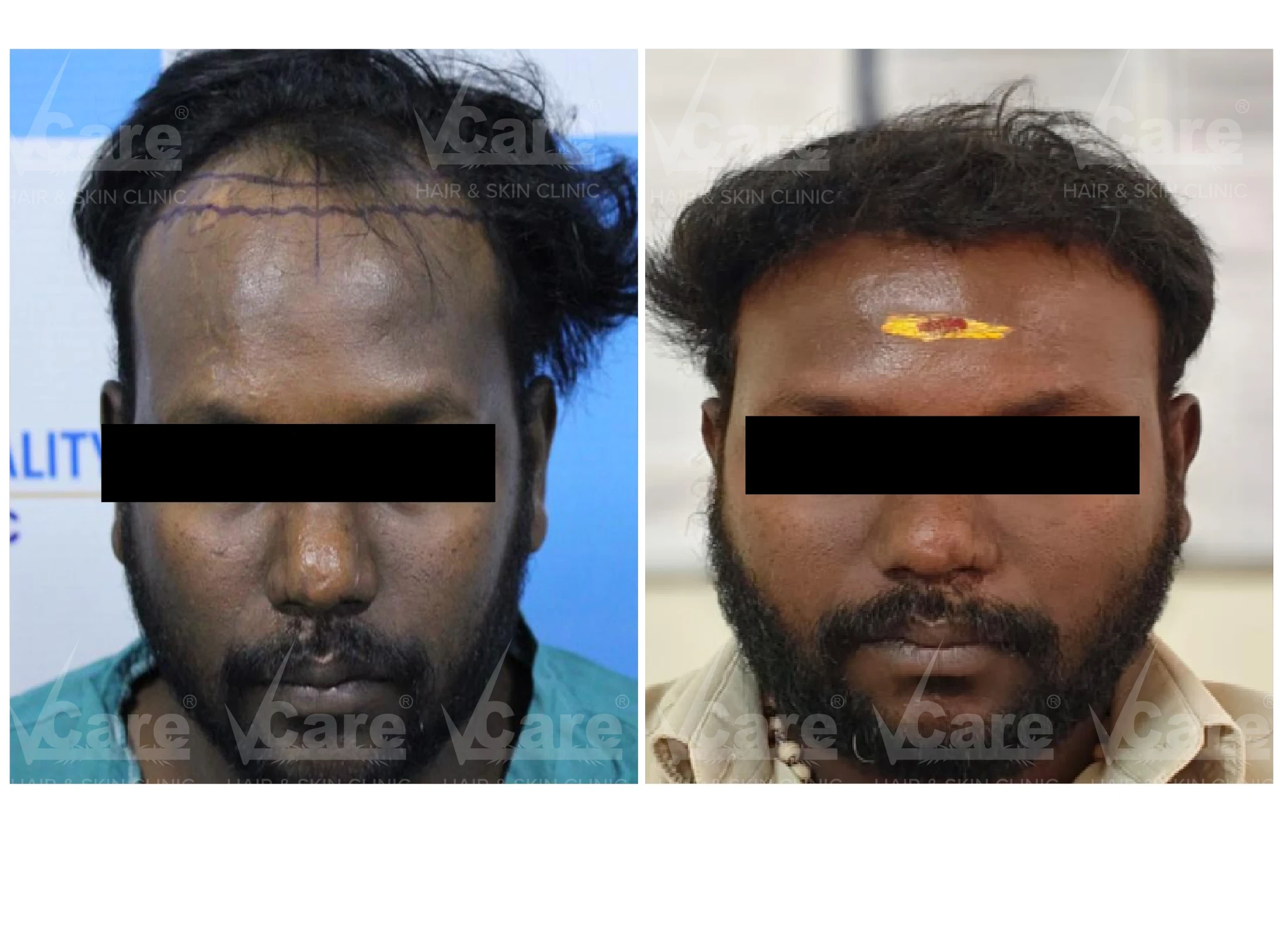 Before & After FUE Hair Transplantation Results