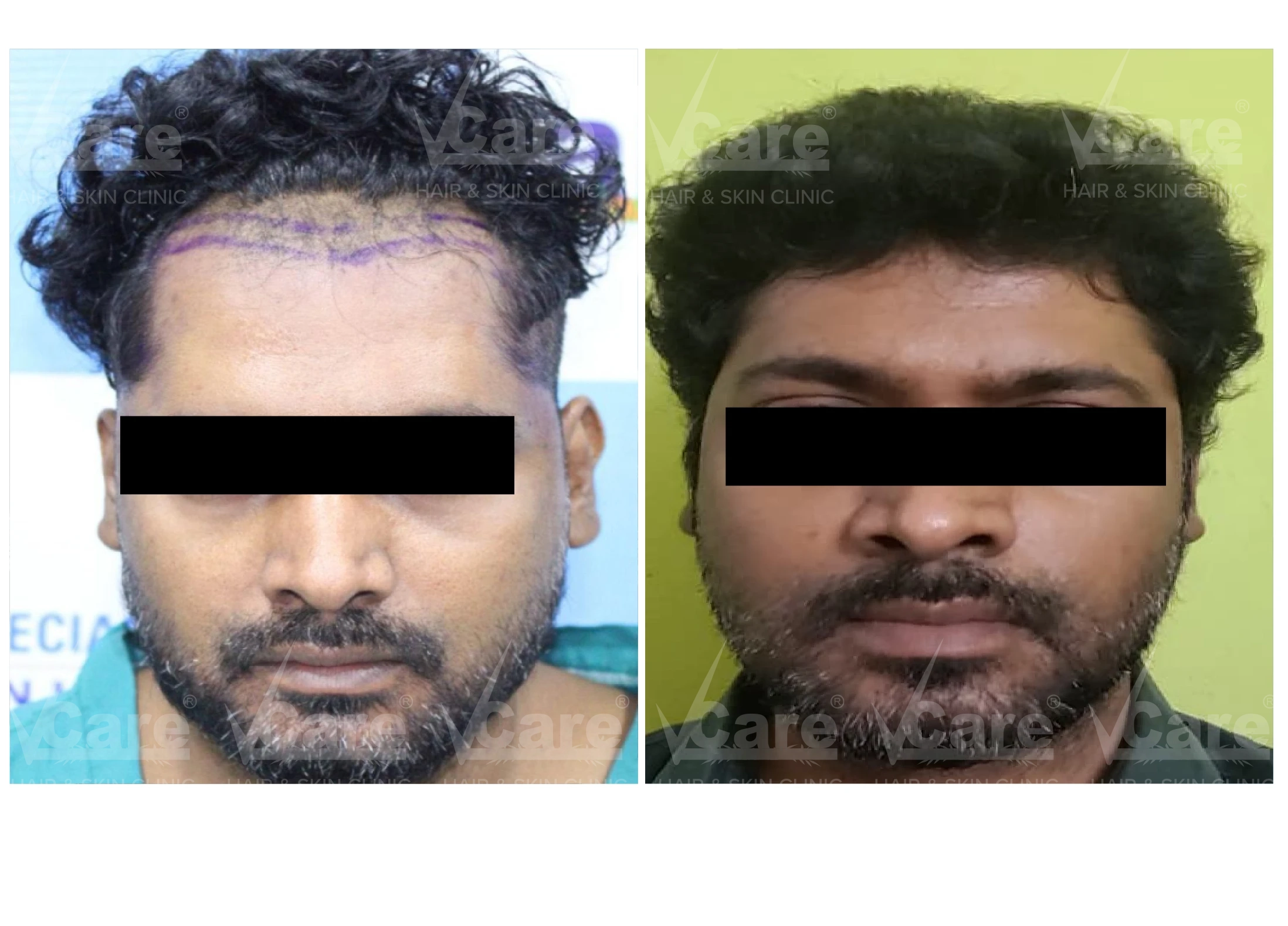 Before & After FUE Hair Transplantation Results