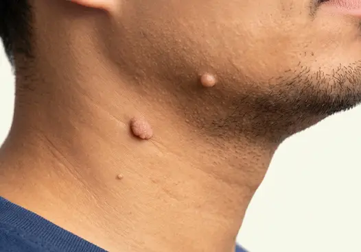 Flesh-Coloured Moles