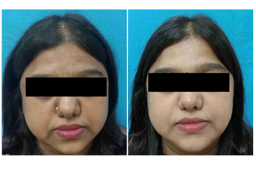 Before & After Results of Skin Lightening Treatment