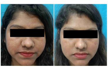 Before & After Results of Skin Lightening Treatment