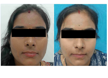 Before & After Results of Skin Lightening Treatment