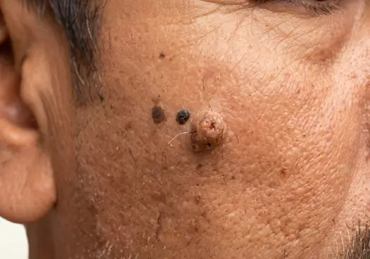 Hairy Moles