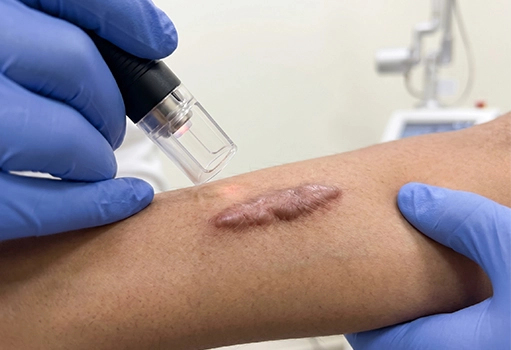 Hypertrophic Scars