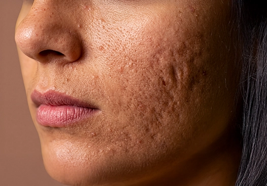 Individuals with acne scars or post-acne marks