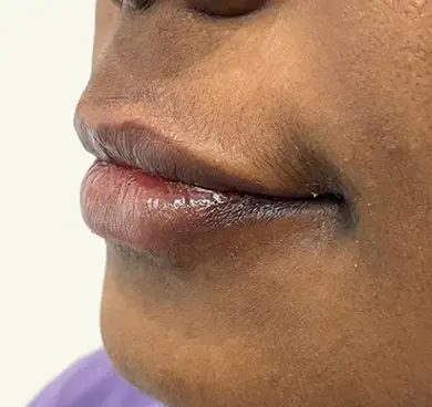 Individuals with dark or pigmented lips