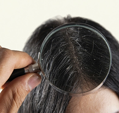 Individuals with dandruff or scalp oil imbalance