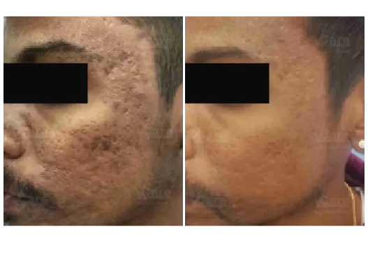 Before & After Microneedling Treatment Results