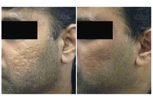 Before & After Microneedling Treatment Results