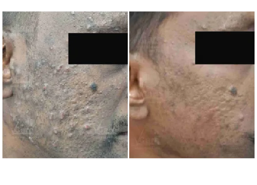 Before & After Microneedling Treatment Results