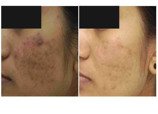 Botox Treatment Before and After