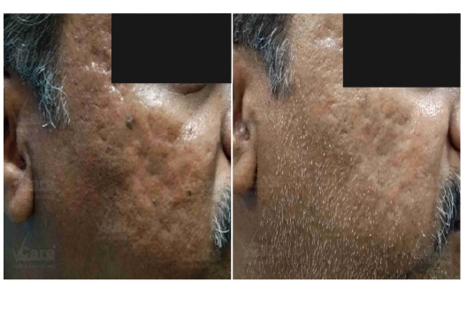 Botox Treatment Before and After
