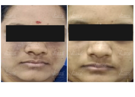 Botox Treatment Before and After
