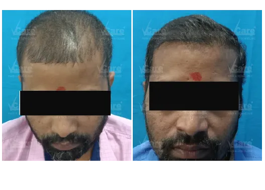 Before & After PRP Hair Treatment Results