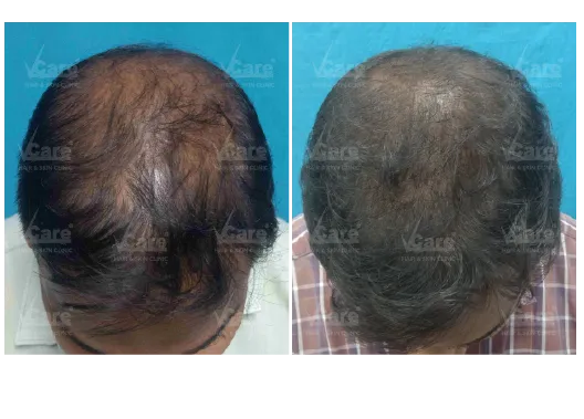 Before & After PRP Hair Treatment Results