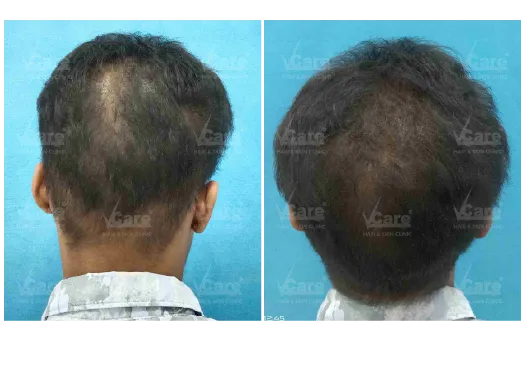 Before & After PRP Hair Treatment Results