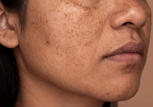 People with uneven skin tone, texture, or pigmentation