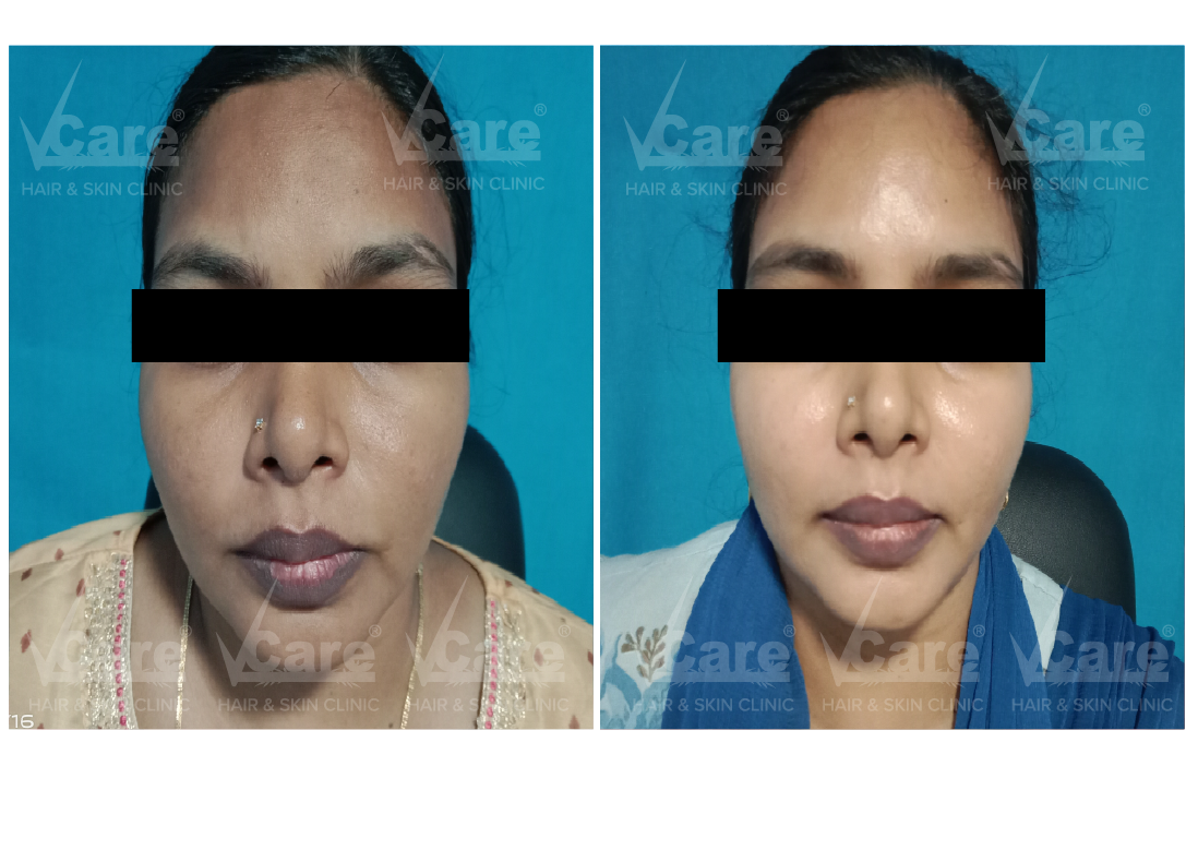 Before & After Pigmentation Treatment Results