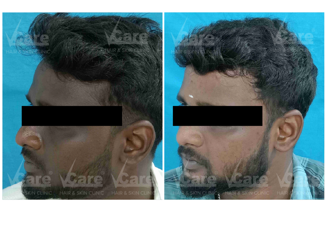 Before & After Pigmentation Treatment Results