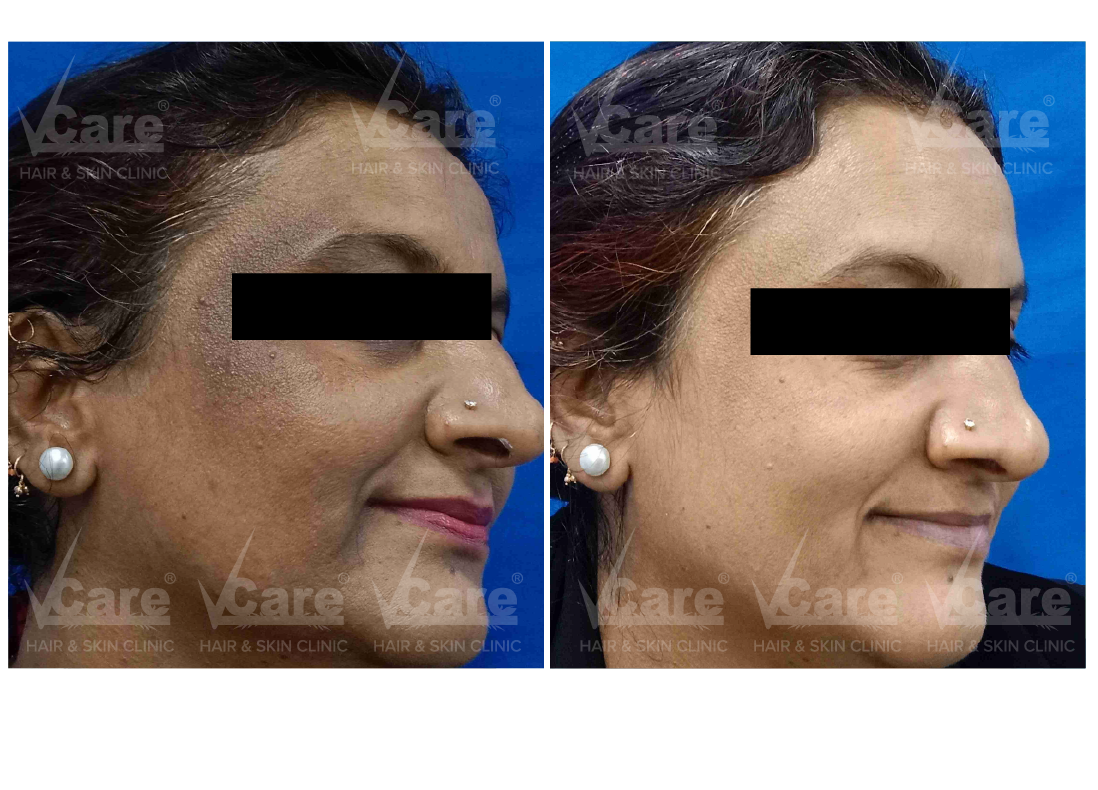 Before & After Pigmentation Treatment Results
