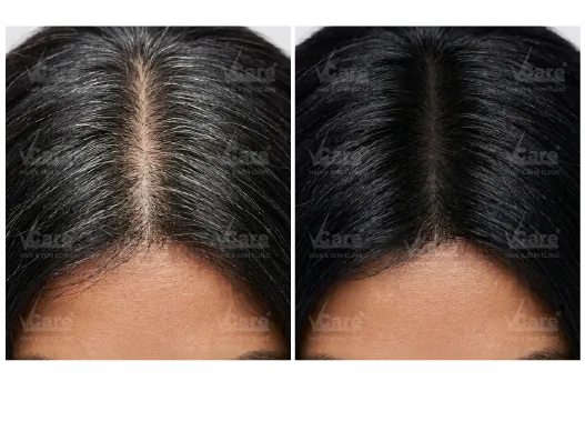 Before & After Premature Grey Hair Treatment Results