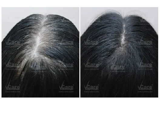 Before & After Premature Grey Hair Treatment Results