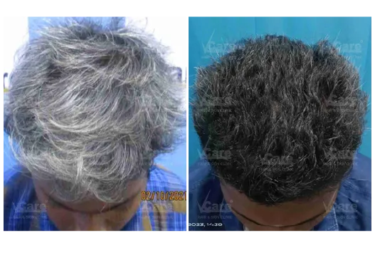 Before & After Premature Grey Hair Treatment Results