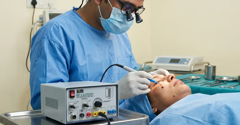 RF Cautery Technology (for surface-level moles)
