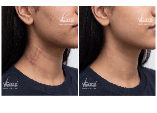 Before & After Scar Removal Treatment Results
