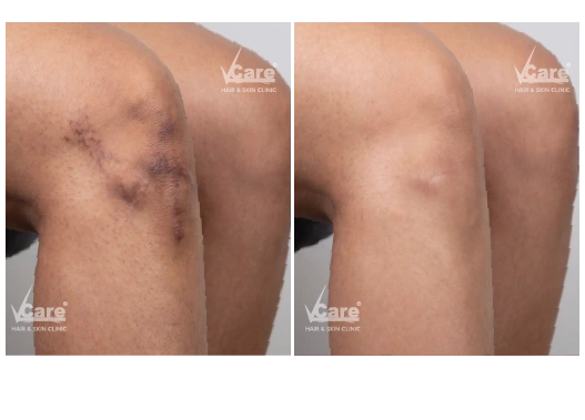 Before & After Scar Removal Treatment Results