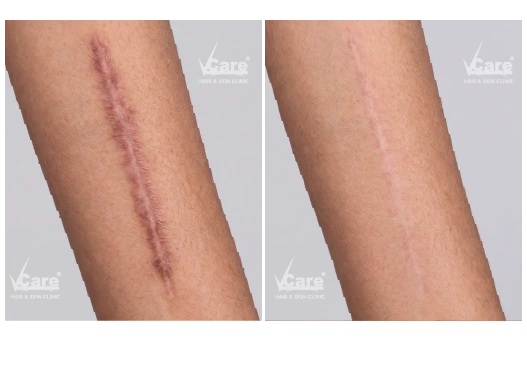 Before & After Scar Removal Treatment Results