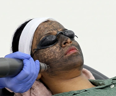 Carbon Laser Peel