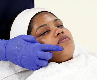 Chemical Peel for Skin Whitening