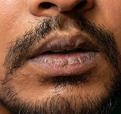 Smoker’s lips or sun-damaged lips