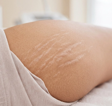 Individuals concerned about stretch marks on stomach, stretch marks on back, stretch marks on shoulders, or stretch marks on thighs