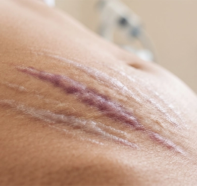 Men and women with visible red, purple, or white stretch marks