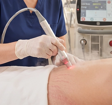 People looking for a non-surgical solution to improve stretch mark visibility